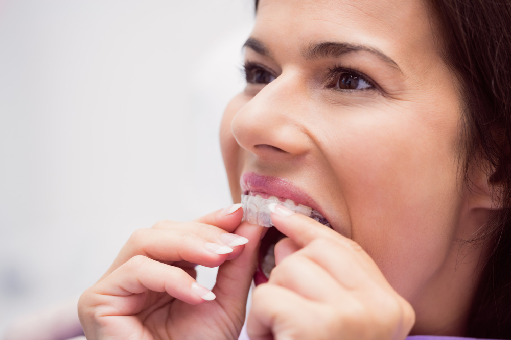 invisalign aligners