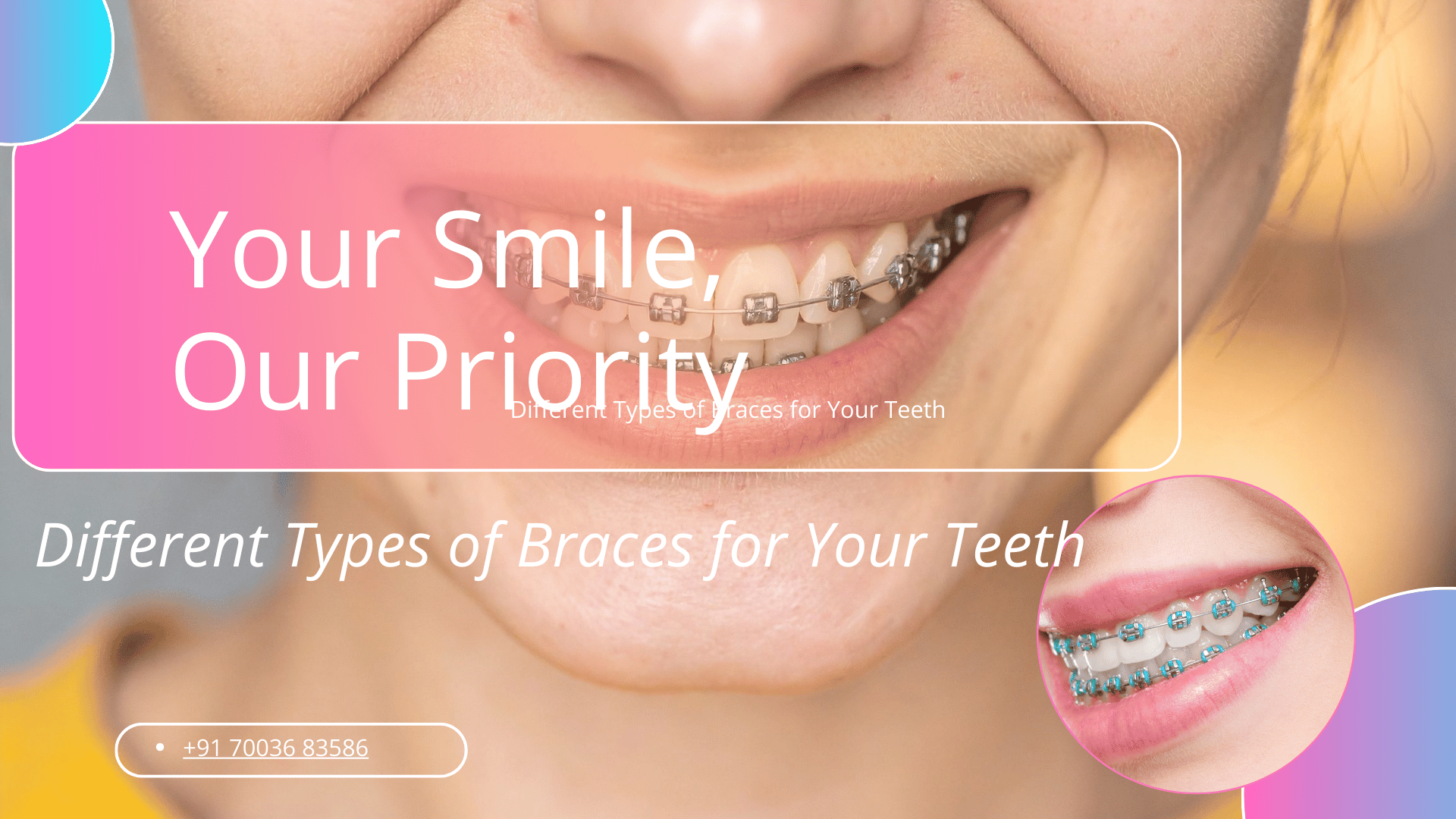 Types of Braces