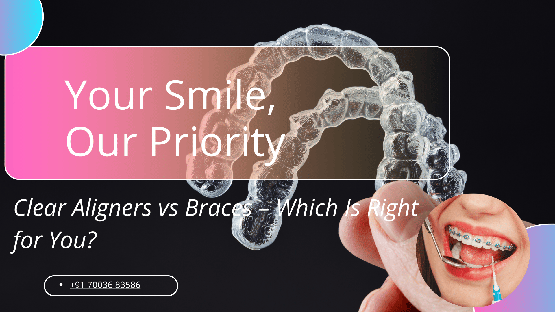Aligners vs Braces