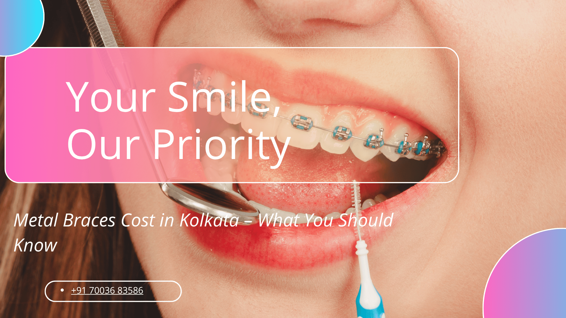 Metal Braces Cost in Kolkata