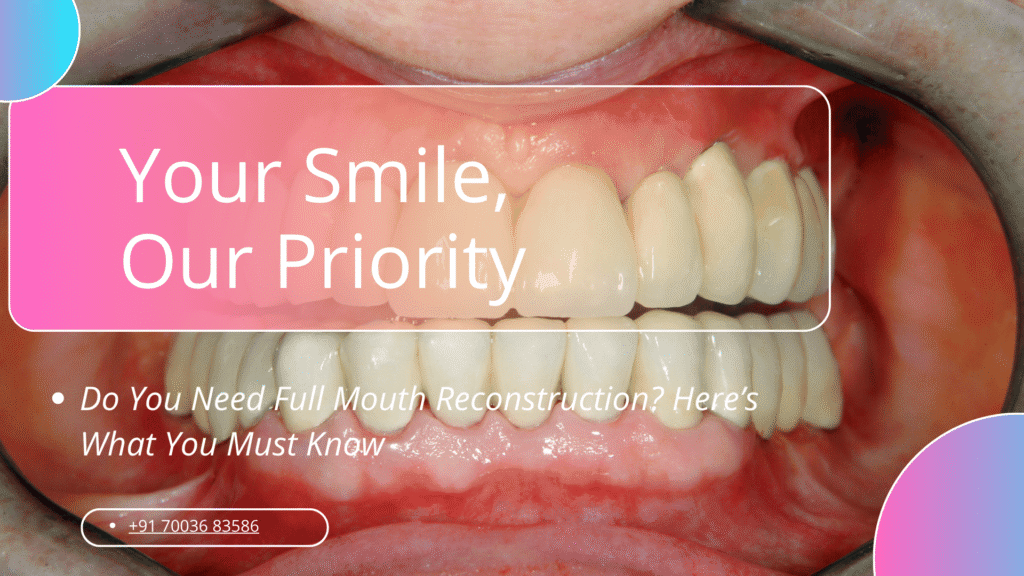 full mouth reconstruction